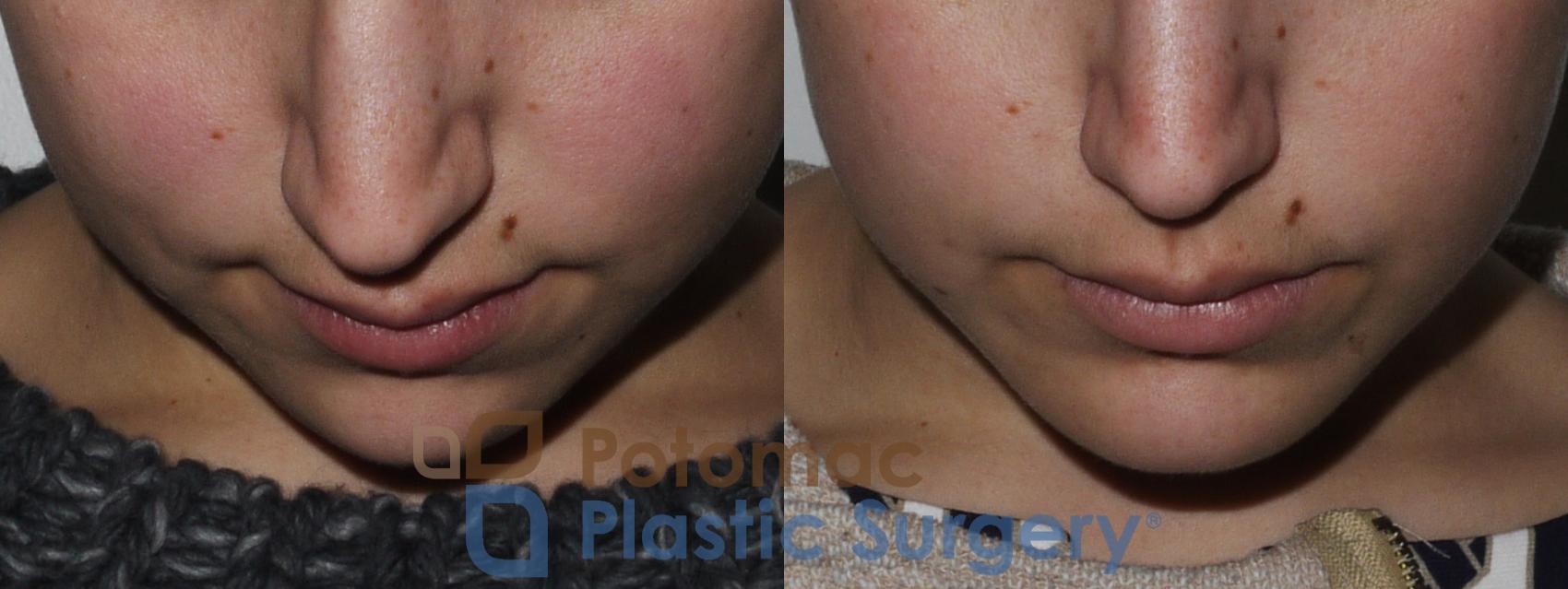 Before & After Facial Sculpting Case 171 Above View in Washington, DC