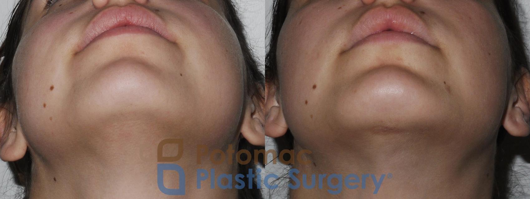 Before & After Facial Sculpting Case 171 Below View in Washington, DC