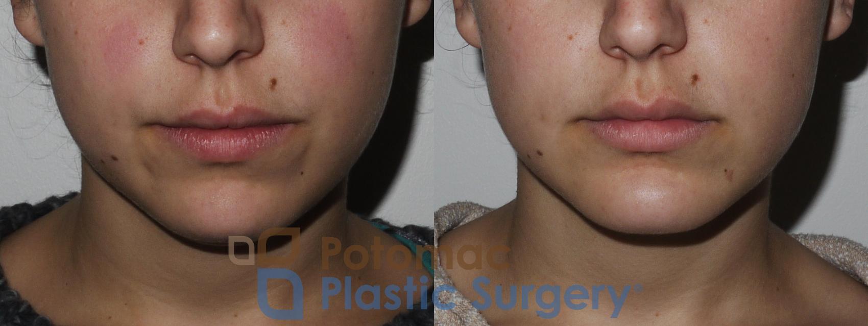 Before & After Facial Sculpting Case 171 Front View in Washington, DC
