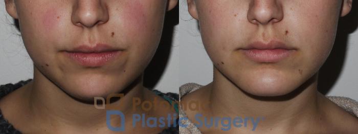 Before & After Facial Sculpting Case 171 Front View in Washington, DC