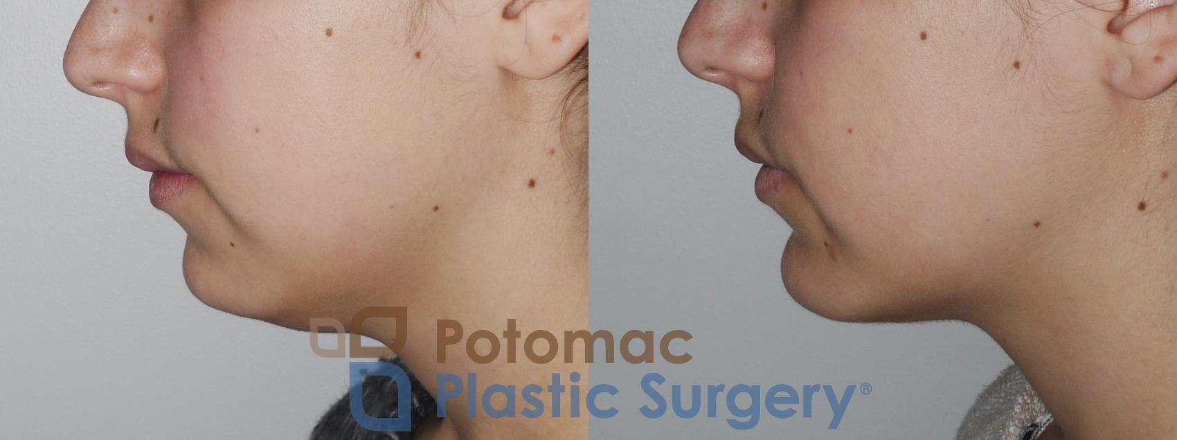 Before & After Facial Sculpting Case 171 Left Side View in Washington, DC