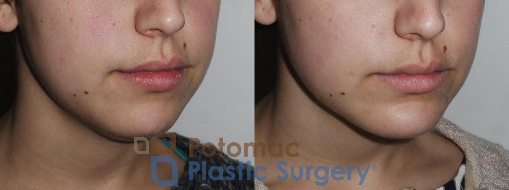 Before & After Facial Sculpting Case 171 Right Oblique View in Washington, DC