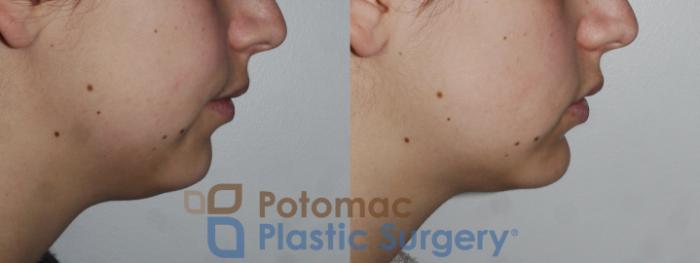 Before & After Facial Sculpting Case 171 Right Side View in Washington, DC