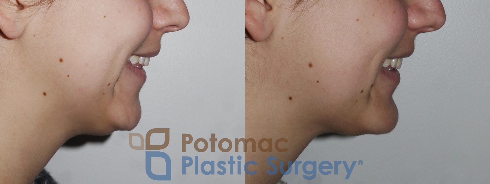 Before & After Facial Sculpting Case 171 Right Side View #2 View in Washington, DC