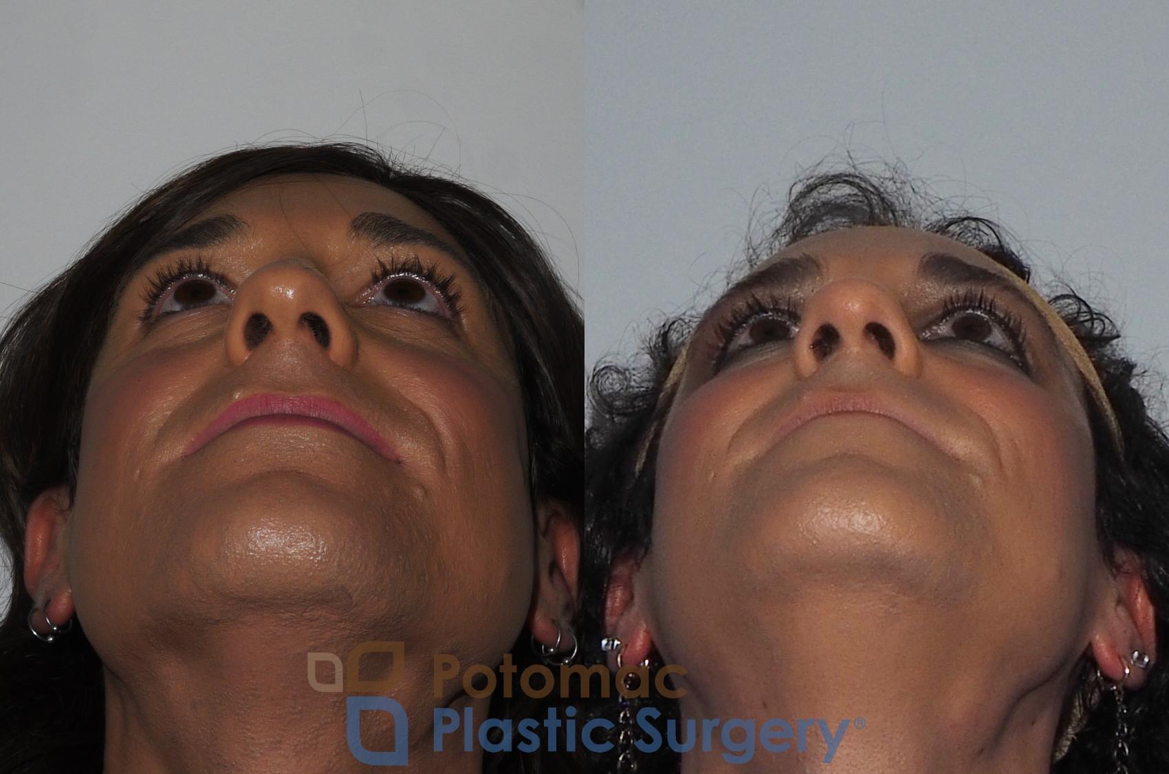 Before & After Botox Cosmetic Case 224 Bottom View in Washington DC & Arlington , DC