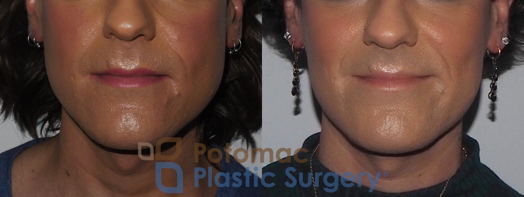 Before & After Facial Sculpting Case 224 Front View in Washington, DC
