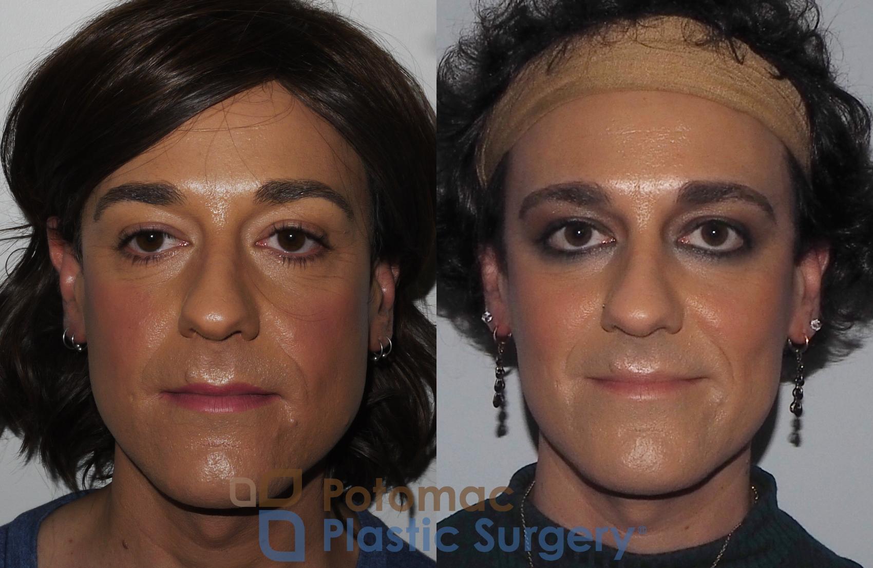 Before & After Botox Cosmetic Case 224 Front View #2 View in Washington DC & Arlington , DC