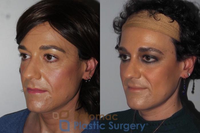 Before & After Facial Sculpting Case 224 Left Oblique View in Washington, DC