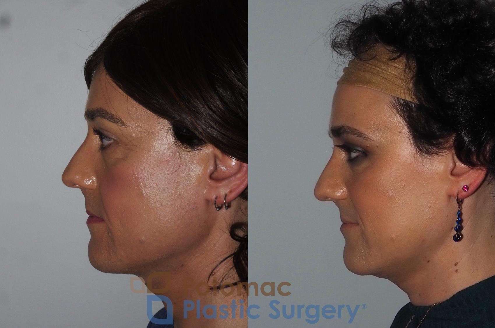 Before & After Botox Cosmetic Case 224 Left Side View in Washington DC & Arlington , DC