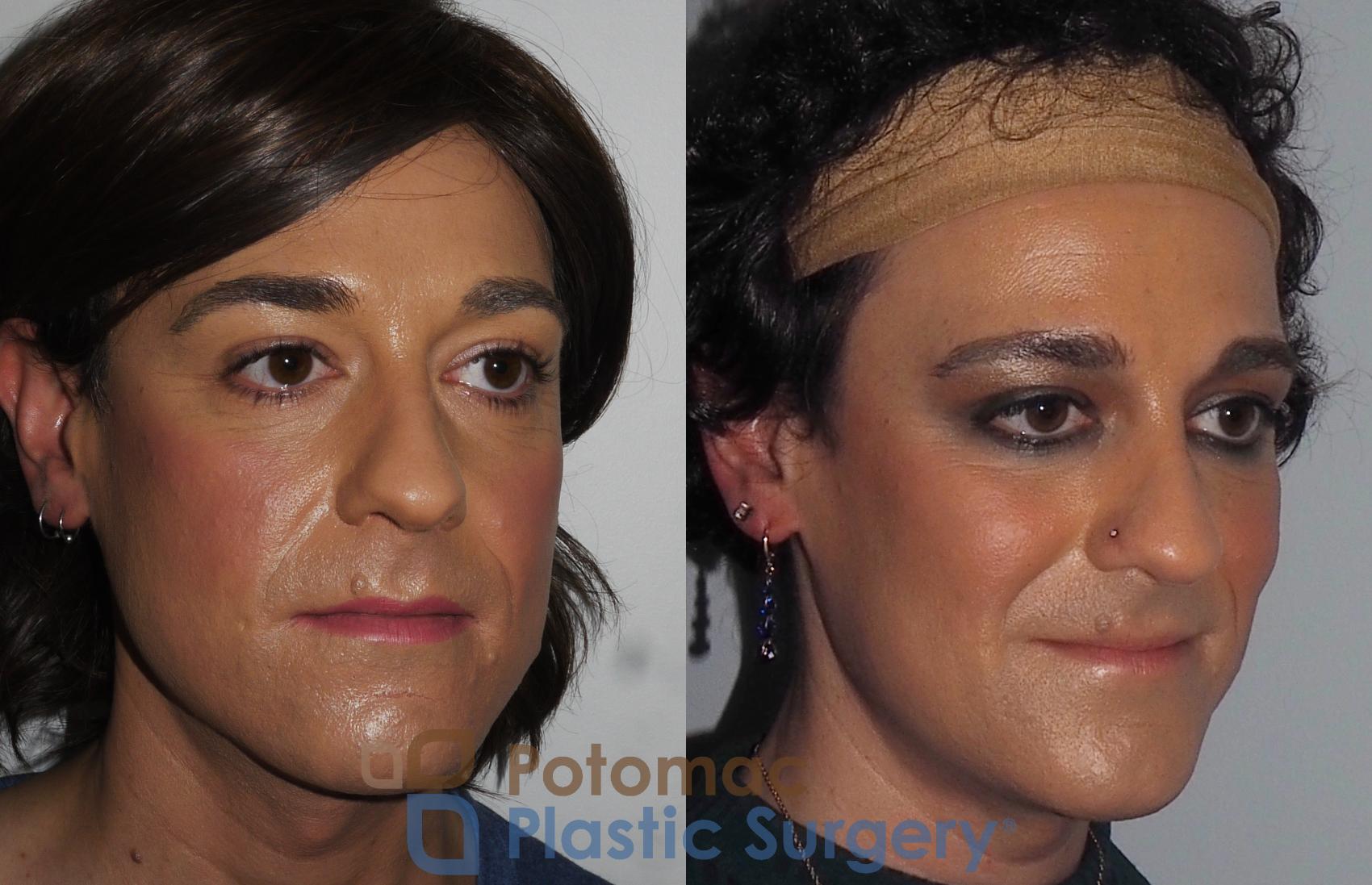 Before & After Botox Cosmetic Case 224 Right Oblique View in Washington DC & Arlington , DC