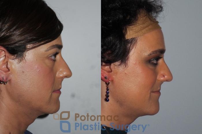 Before & After Facial Sculpting Case 224 Right Side View in Washington, DC