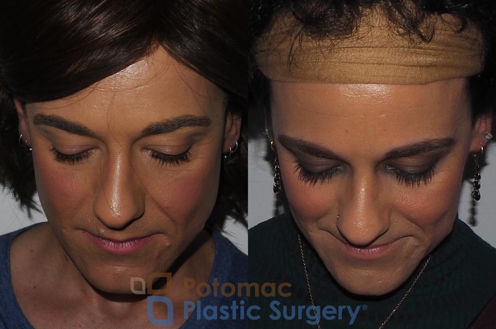 Before & After Botox Cosmetic Case 224 Top View in Washington DC & Arlington , DC