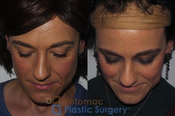 Before & After Facial Sculpting Case 224 Top View in Washington, DC