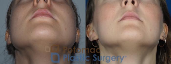 Before & After Facial Sculpting Case 228 Bottom View in Washington DC & Arlington , DC