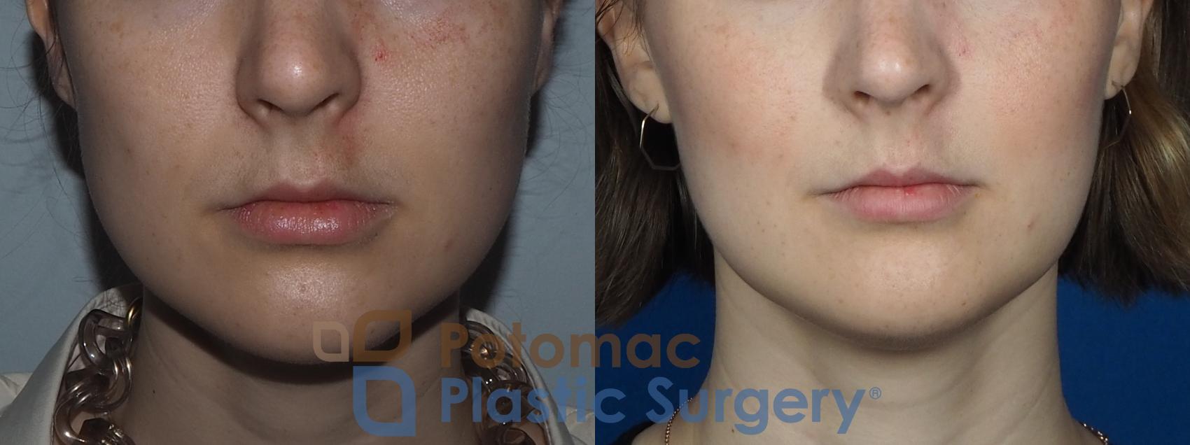 Before & After Facial Sculpting Case 228 Front View in Washington, DC