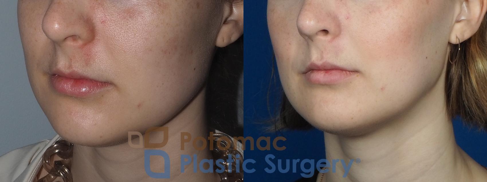 Before & After Facial Sculpting Case 228 Left Oblique View in Washington DC & Arlington , DC