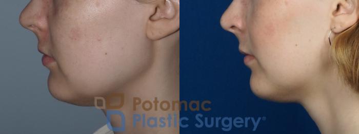 Before & After Facial Sculpting Case 228 Left Side View in Washington DC & Arlington , DC