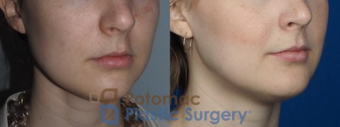 Before & After Facial Sculpting Case 228 Right Oblique View in Washington DC & Arlington , DC