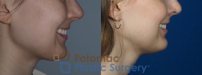 Before & After Botox Cosmetic Case 228 Right Side View in Washington DC & Arlington , DC