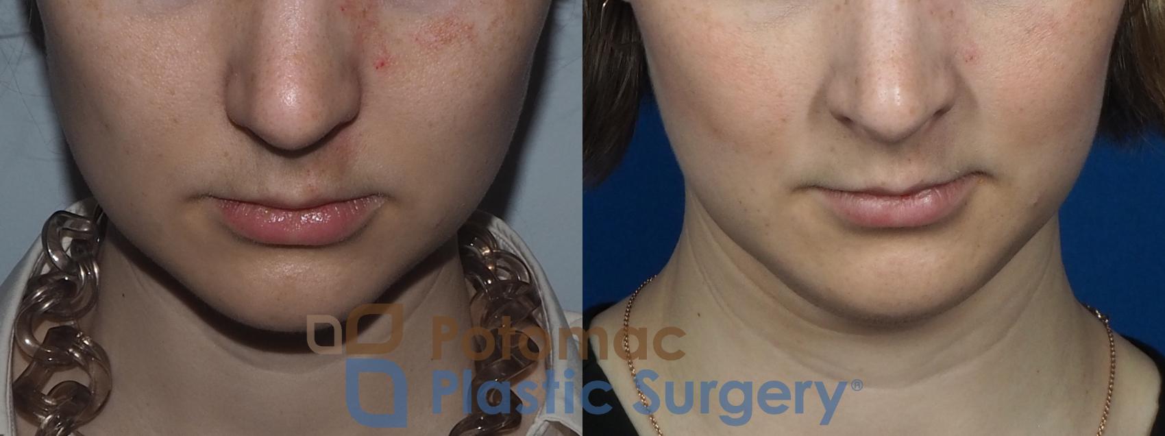 Before & After Facial Sculpting Case 228 Top View in Washington DC & Arlington , DC
