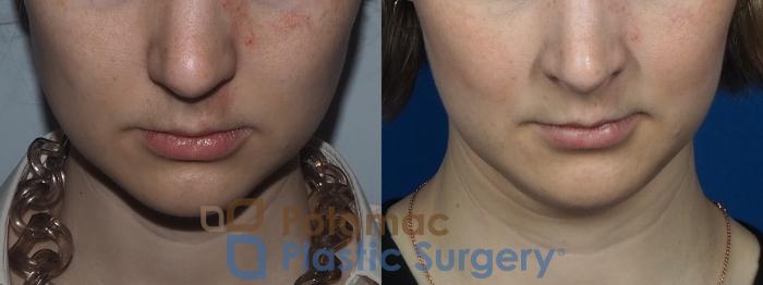 Before & After Botox Cosmetic Case 228 Top View in Washington DC & Arlington , DC