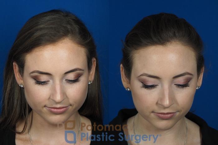 Before & After Liquid Facelift Case 246 Above View in Washington DC & Arlington , DC