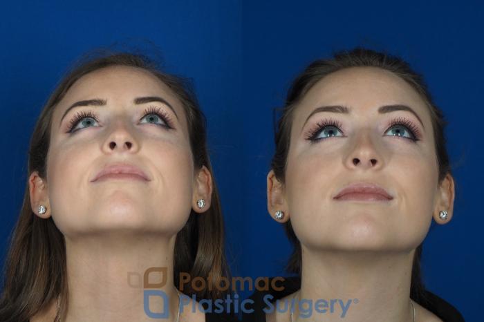 Before & After Facial Sculpting Case 246 Below View in Washington DC & Arlington , DC