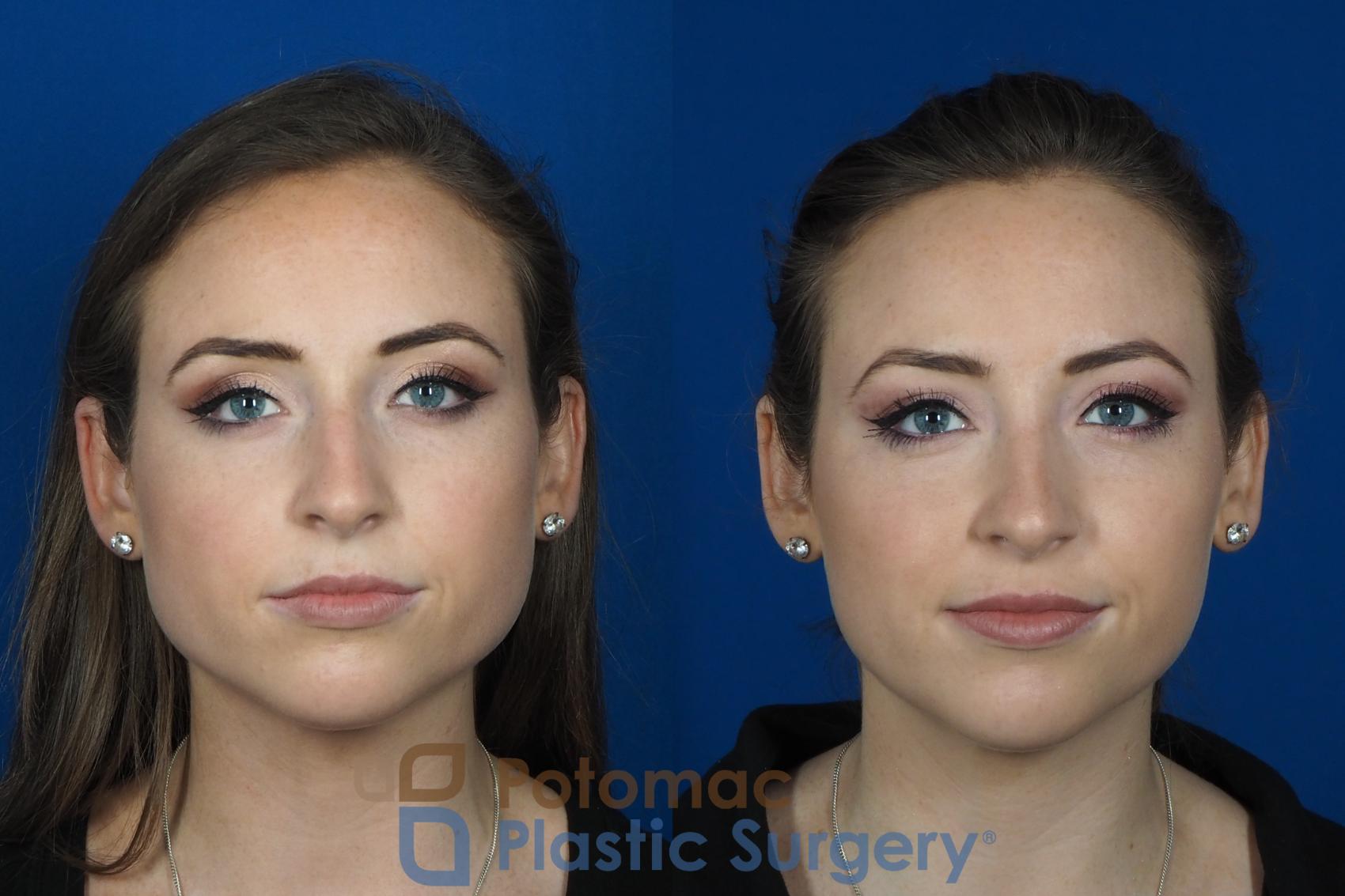 Before & After Botox Cosmetic Case 246 Front View #1 View in Washington DC & Arlington , DC