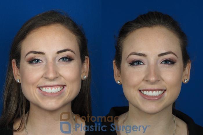 Before & After Facial Sculpting Case 246 Front View #2 View in Washington DC & Arlington , DC