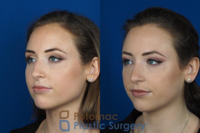 Before & After Facial Sculpting Case 246 Left Oblique View in Washington DC & Arlington , DC