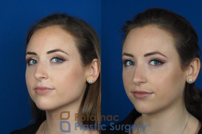 Before & After Botox Cosmetic Case 246 Left Oblique View #2 View in Washington DC & Arlington , DC