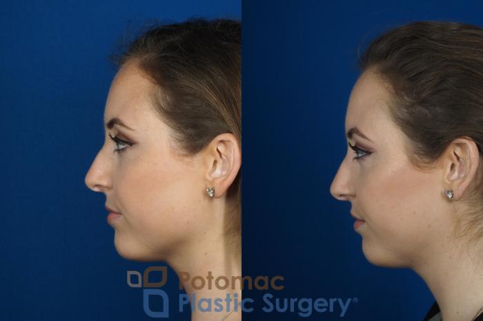 Before & After Botox Cosmetic Case 246 Left Side View in Washington DC & Arlington , DC