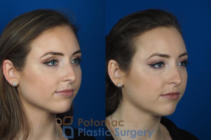 Before & After Facial Sculpting Case 246 Right Oblique View in Washington DC & Arlington , DC