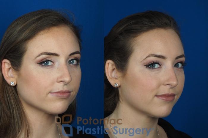 Before & After Facial Sculpting Case 246 Right Oblique View #2 View in Washington DC & Arlington , DC