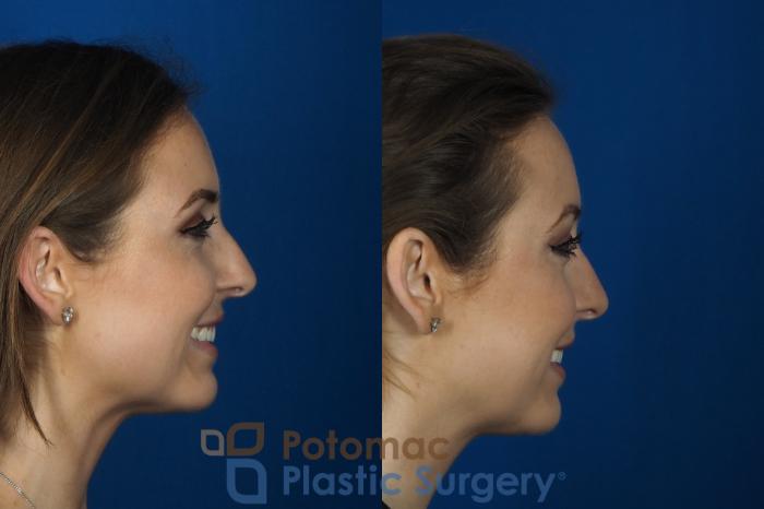 Before & After Facial Sculpting Case 246 Right Side View #2 View in Washington DC & Arlington , DC
