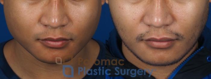 Before & After Facial Sculpting Case 256 Above View in Washington DC & Arlington , DC