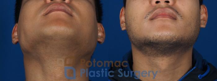 Before & After Botox Cosmetic Case 256 Below View in Washington DC & Arlington , DC