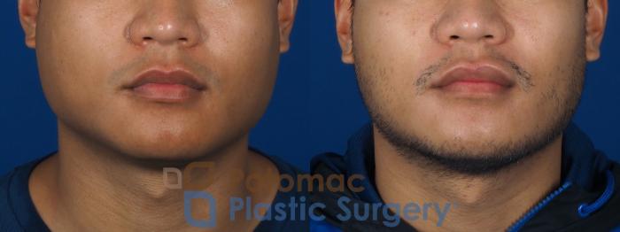 Before & After Facial Sculpting Case 256 Front View in Washington DC & Arlington , DC