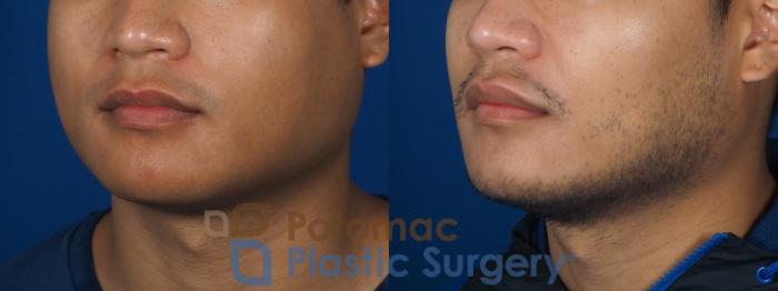 Before & After Facial Sculpting Case 256 Left Oblique View in Washington DC & Arlington , DC