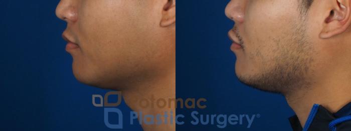 Before & After Facial Sculpting Case 256 Left Side View in Washington DC & Arlington , DC