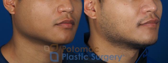 Before & After Botox Cosmetic Case 256 Right Oblique View in Washington DC & Arlington , DC