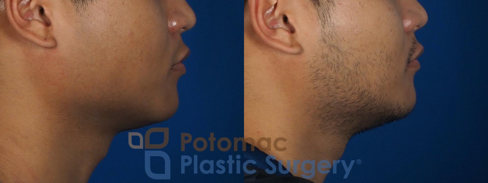Before & After Botox Cosmetic Case 256 Right Side View in Washington DC & Arlington , DC