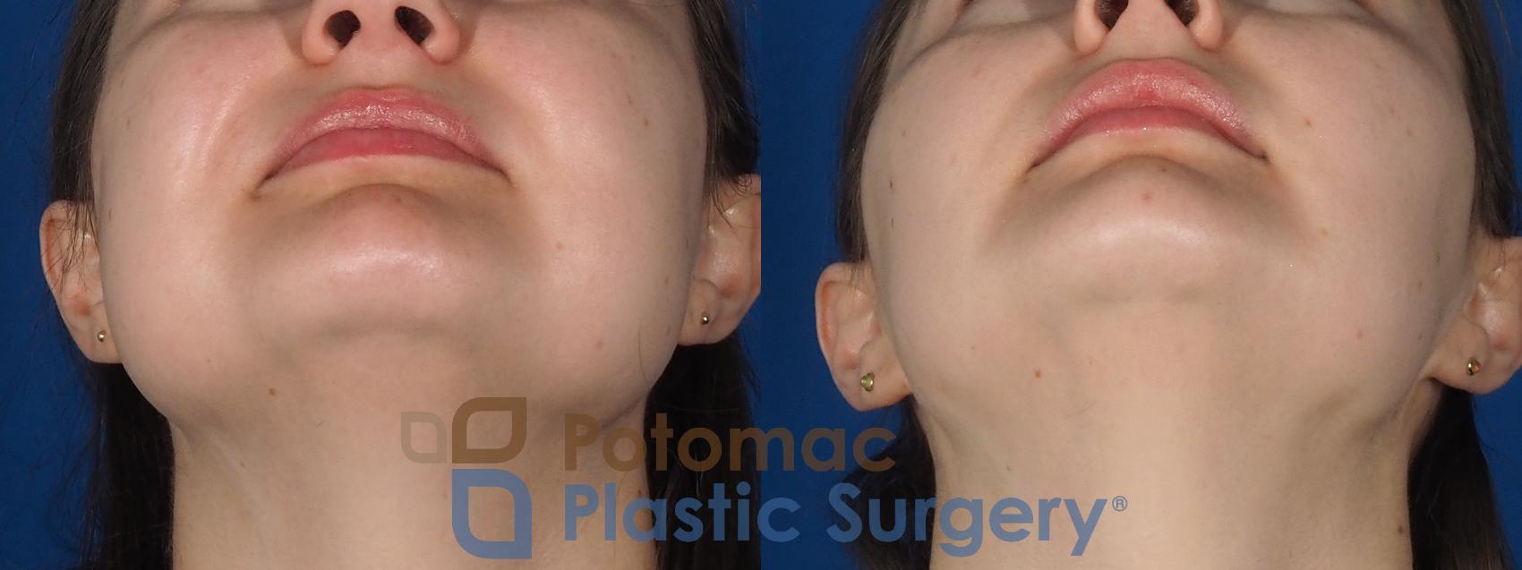 Before & After Facial Sculpting Case 277 Bottom View in Washington, DC