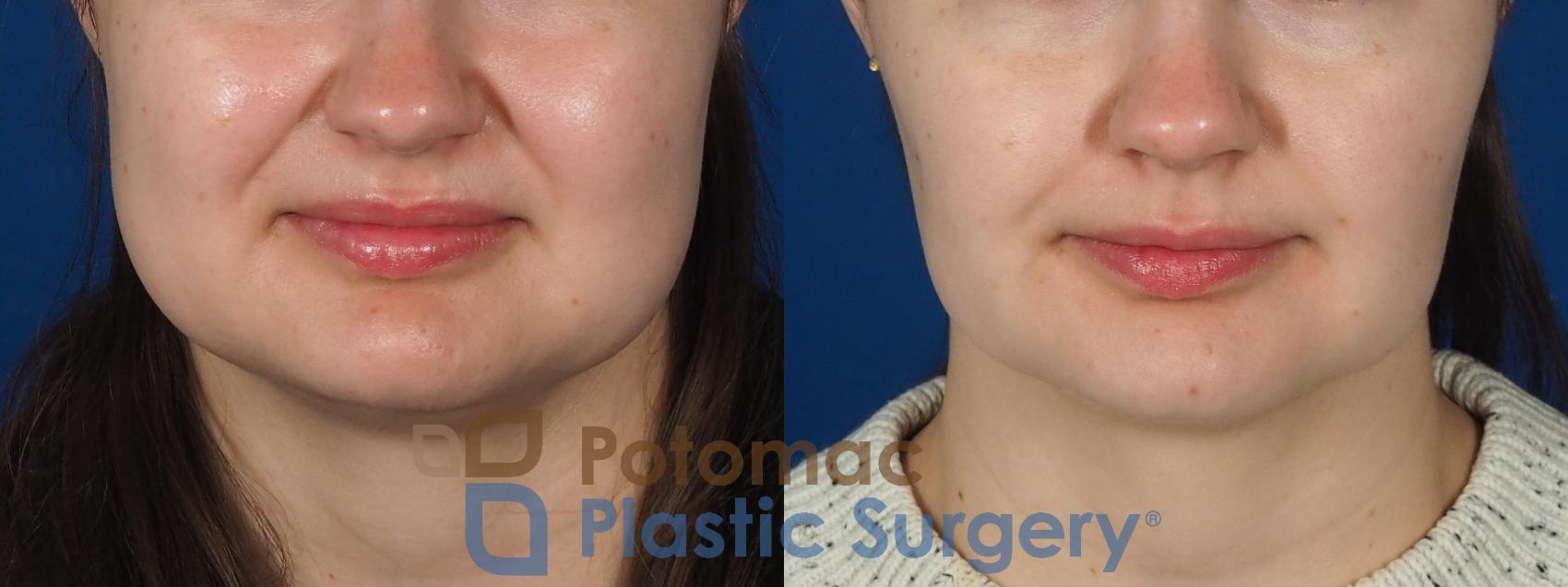 Before & After Buccal Fat Reduction Case 277 Front View in Washington DC & Arlington , DC