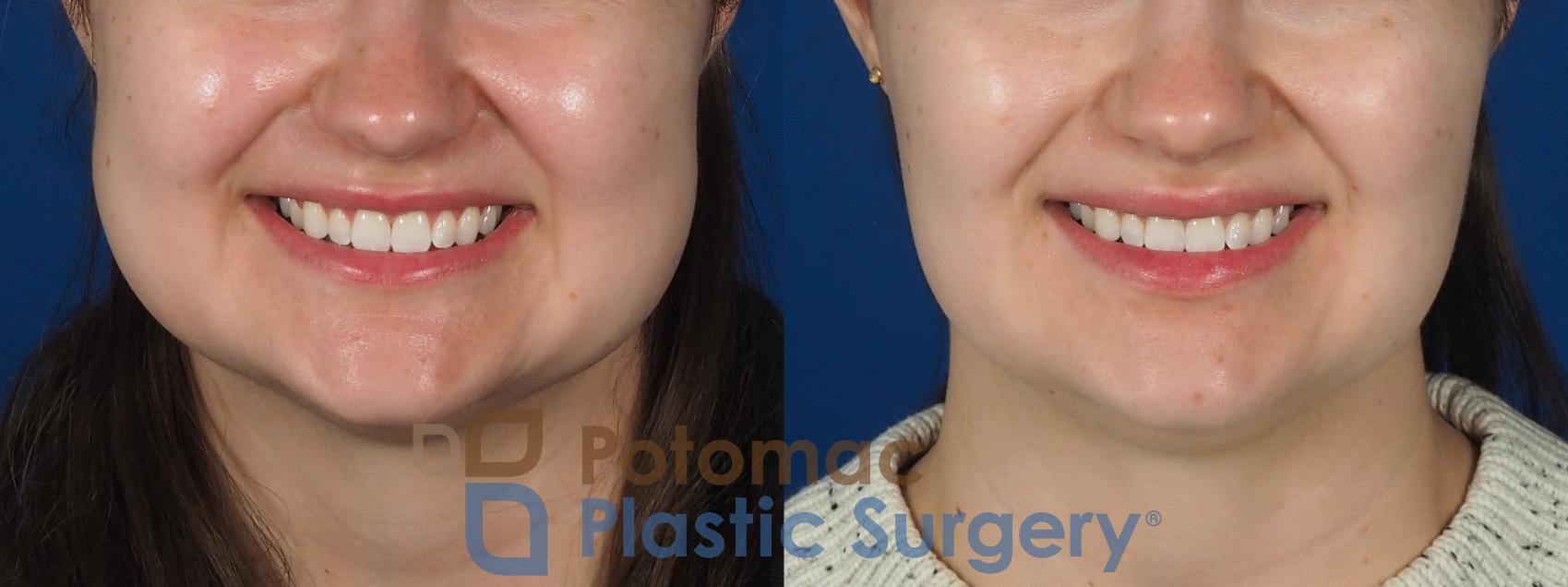Before & After Facial Sculpting Case 277 Front Smiling View in Washington, DC