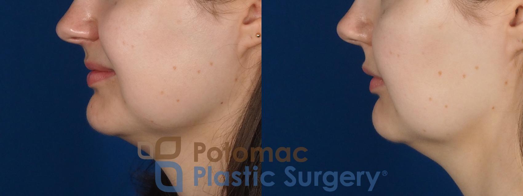 Before & After Buccal Fat Reduction Case 277 Left Side View in Washington DC & Arlington , DC