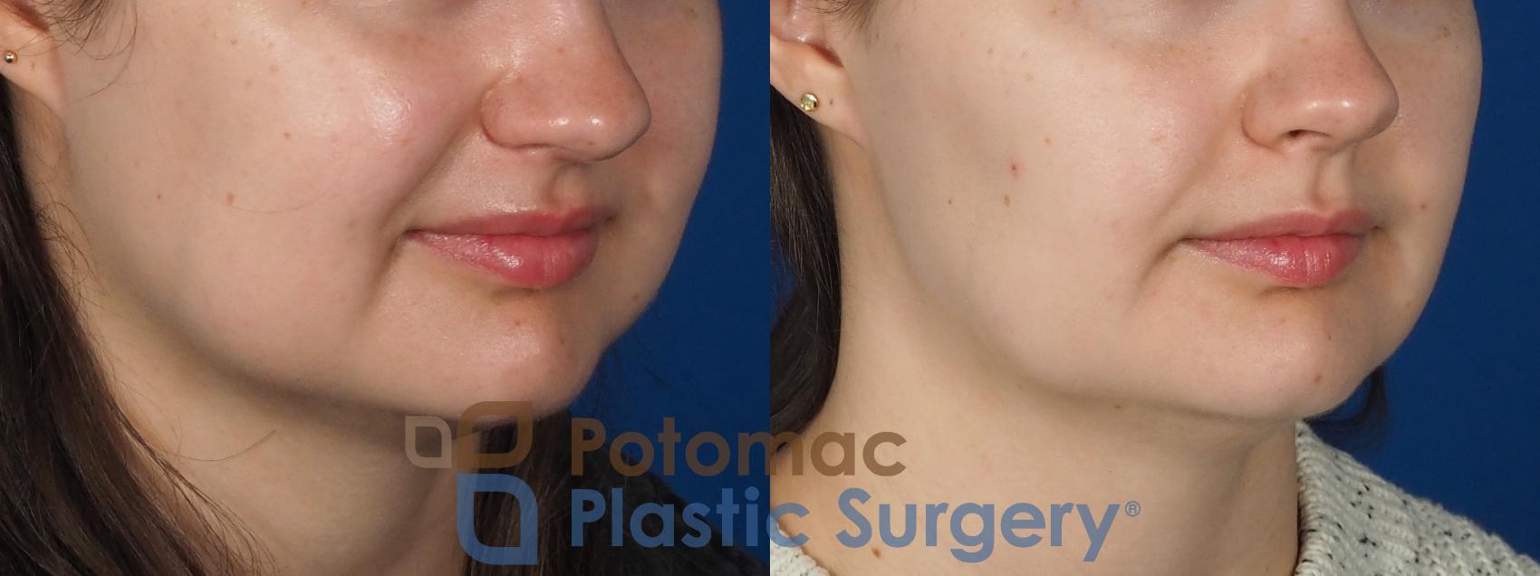 Before & After Facial Sculpting Case 277 Right Oblique View in Washington, DC