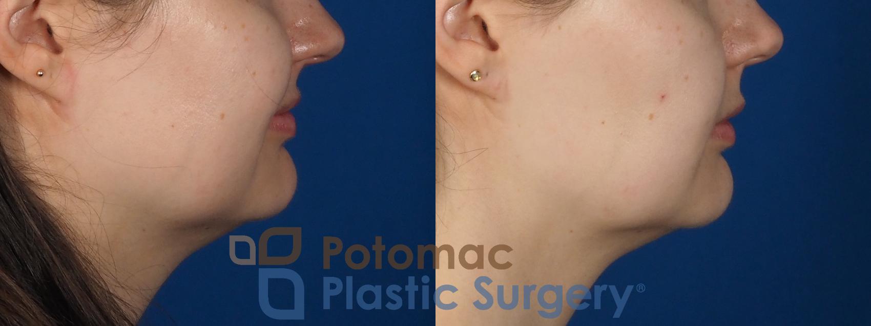 Before & After Facial Sculpting Case 277 Right Side View in Washington, DC