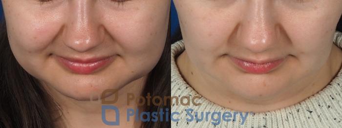 Before & After Facial Sculpting Case 277 Top View in Washington, DC