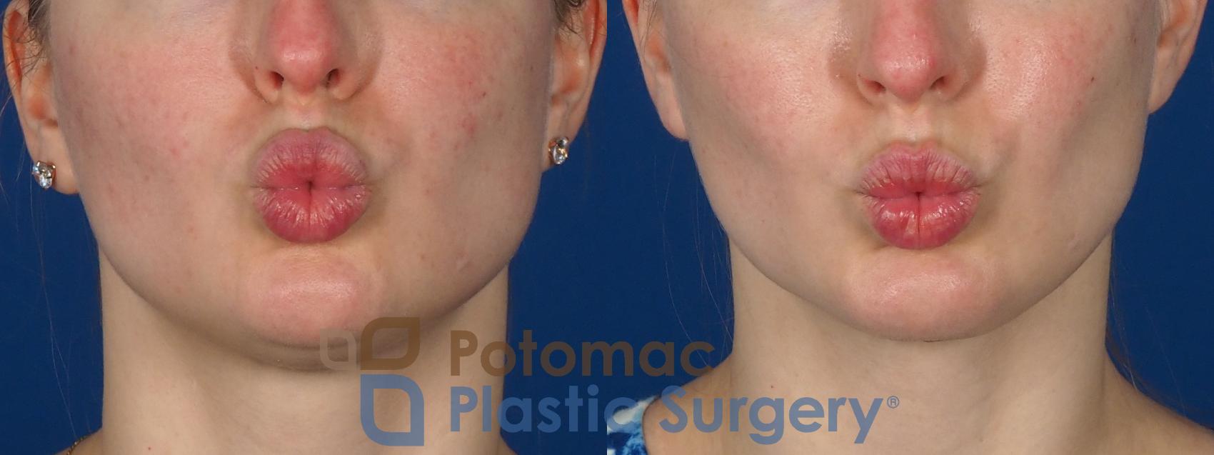 Before & After Facial Sculpting Case 293 Front - Puckering View in Washington DC & Arlington , DC